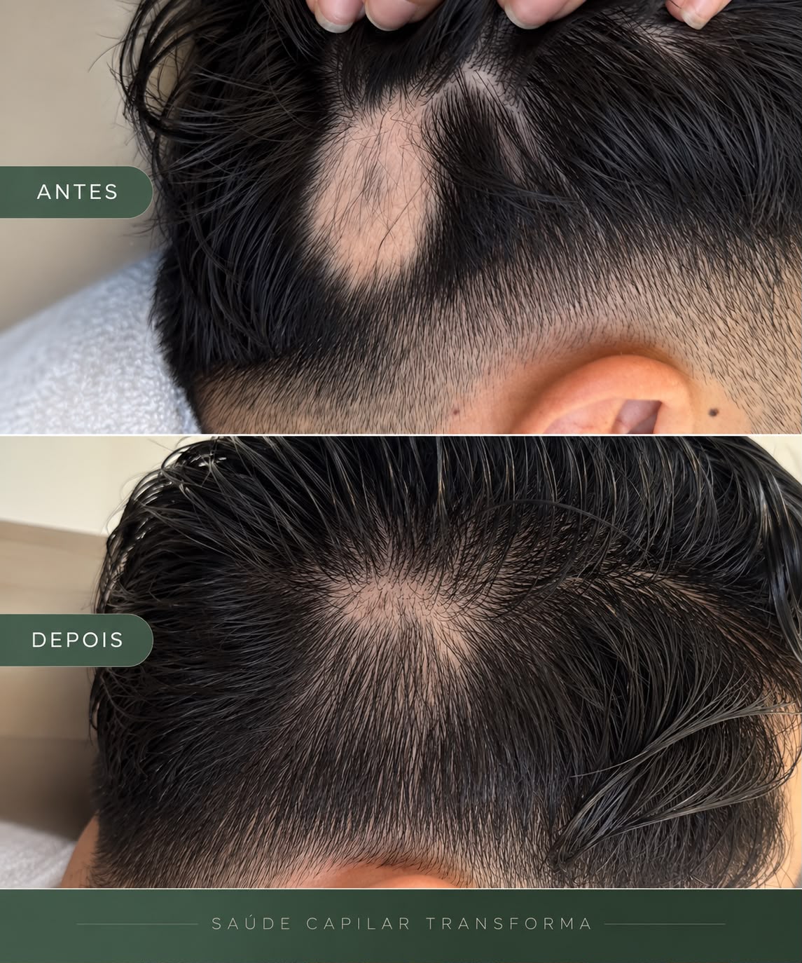 Antes e depois de tratamento capilar para alopecia