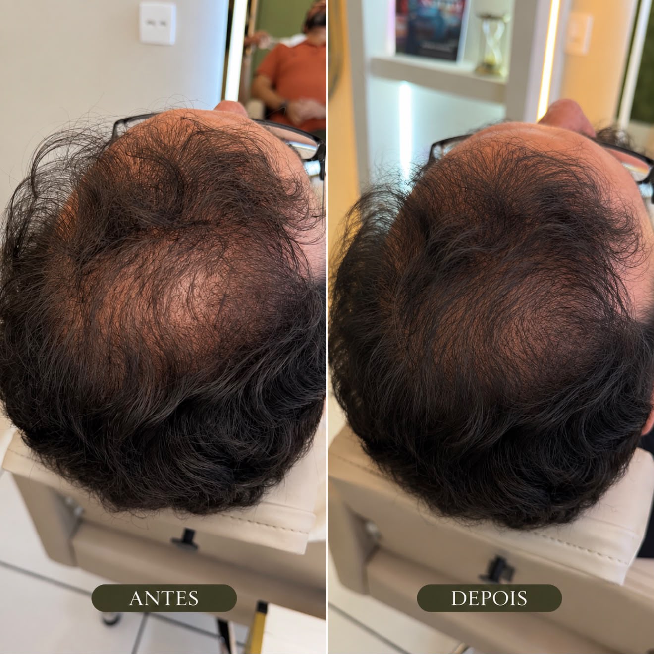 Antes e depois de tratamento para queda capilar
